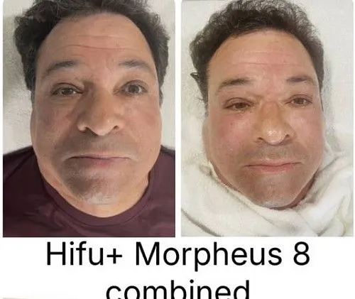 Уход за кожей, депиляция воском, Morpheus 8, коррекция фигуры, татуировки…