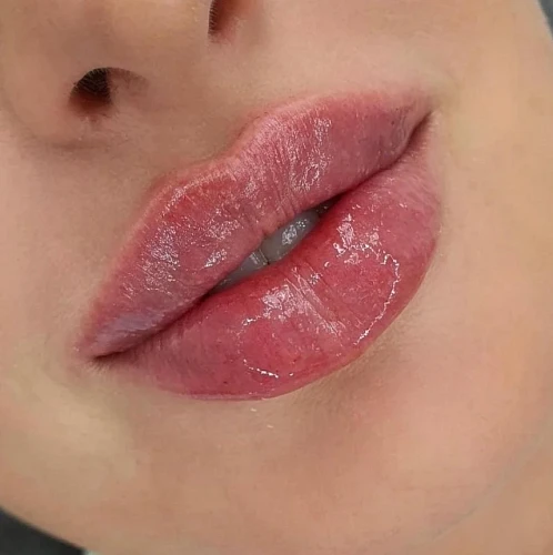 Lip Fillers | Botox | Chicago